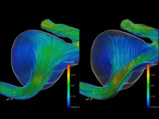 Virtual Stenting + CFD